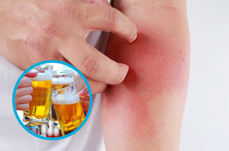 Hiện tượng mẩn ngứa sau khi uống bia