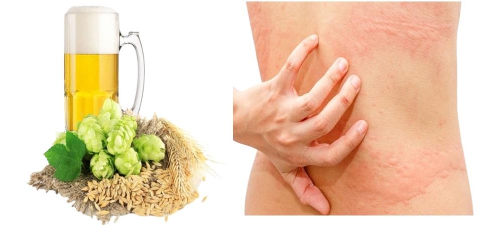 Mẩn đỏ khi uống bia gây ảnh ảnh hưởng đến sức khoẻ