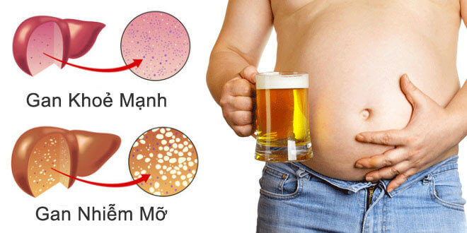 Tác hại của bia với gan và chức năng gan