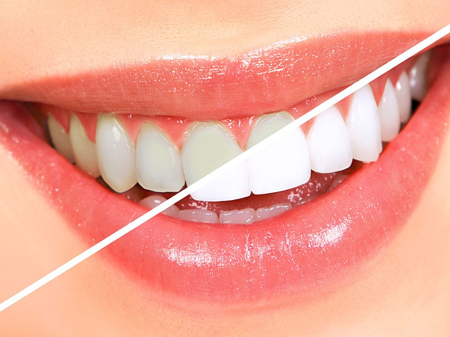 Tẩy trắng răng bao lâu thì được uống bia?