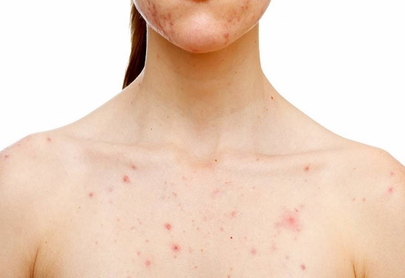Uống bia bị nổi mụn có thể do gan yếu