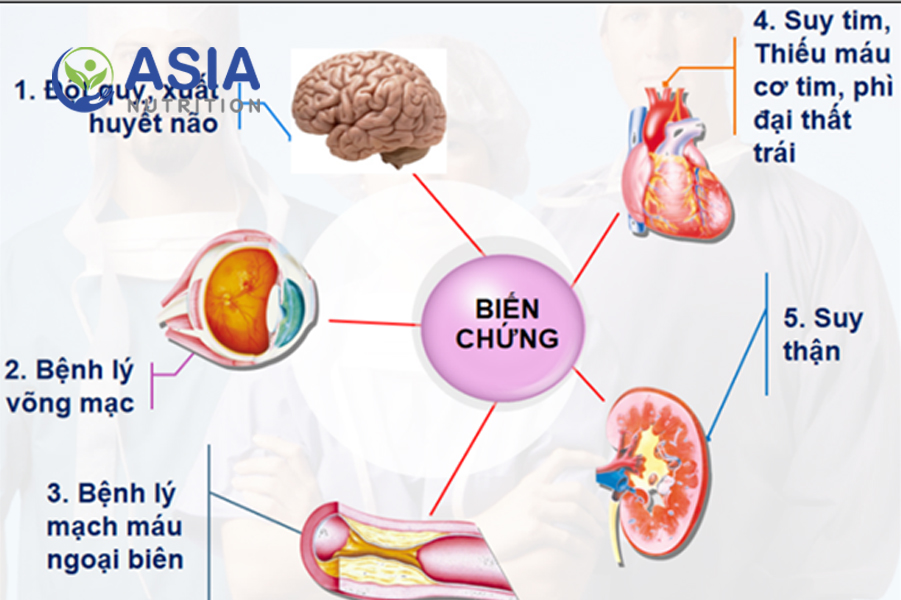 Tăng huyết áp thứ phát: Nguyên nhân, triệu chứng và cách điều trị hiệu quả