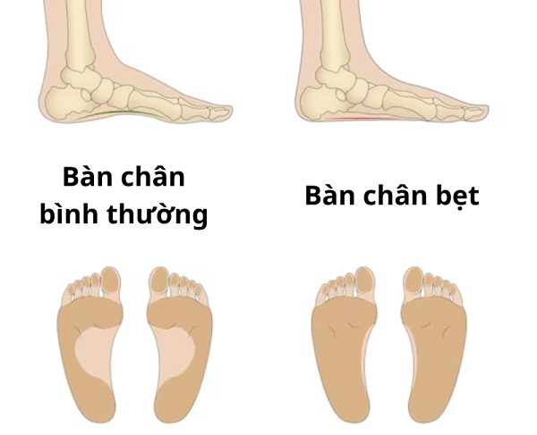 Bàn chân bẹt và cách chọn giày chạy bộ lý tưởng
