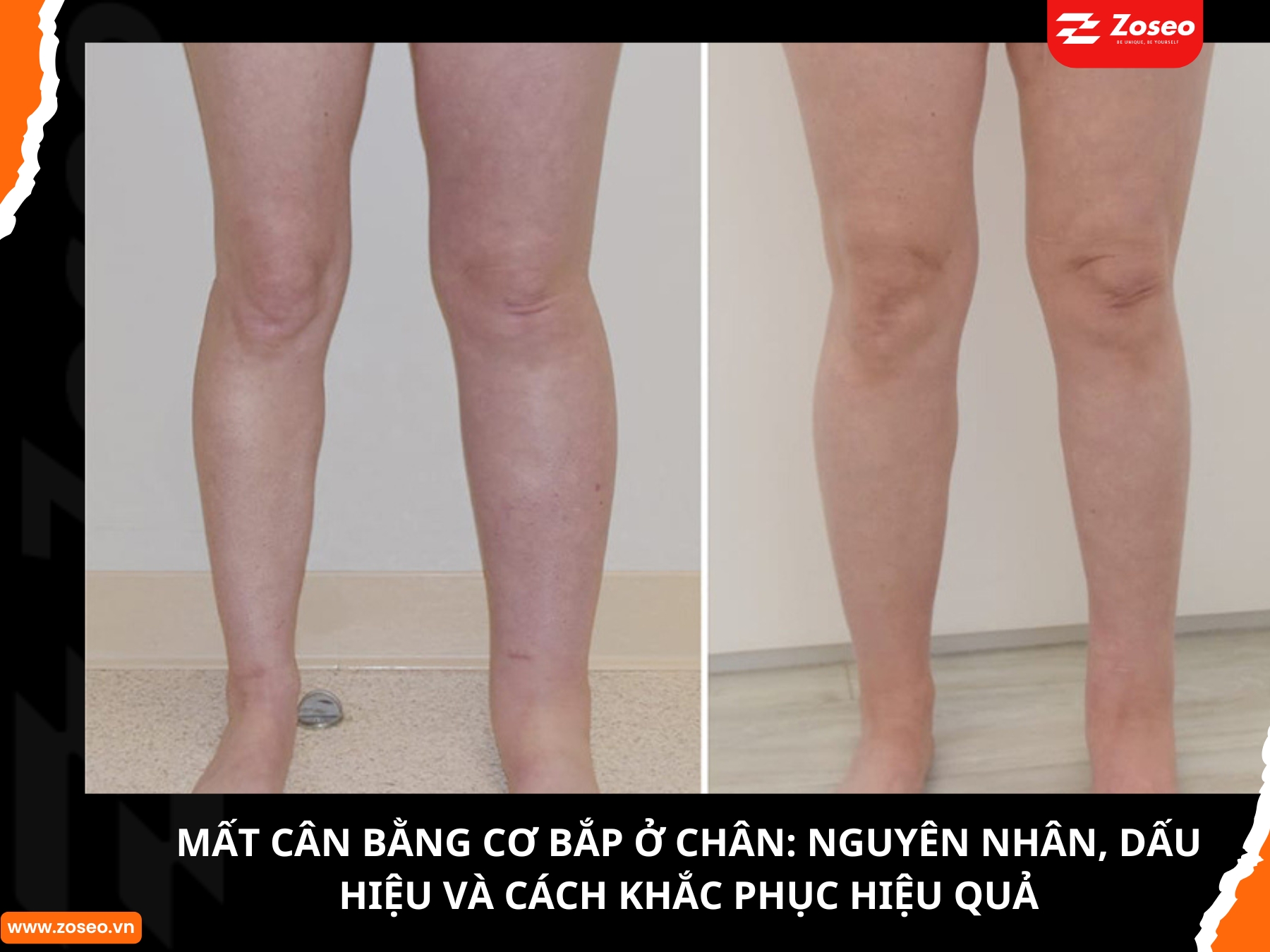Mất cân bằng cơ bắp ở chân: Nguyên nhân, dấu hiệu và cách khắc phục hiệu quả