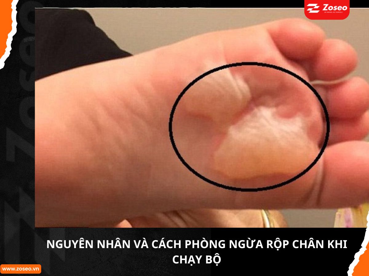 Nguyên nhân và cách phòng ngừa phồng rộp chân khi chạy bộ