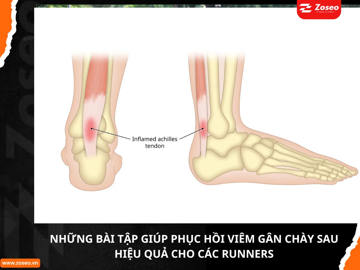 Những bài tập giúp phục hồi viêm gân chày sau hiệu quả cho các runners