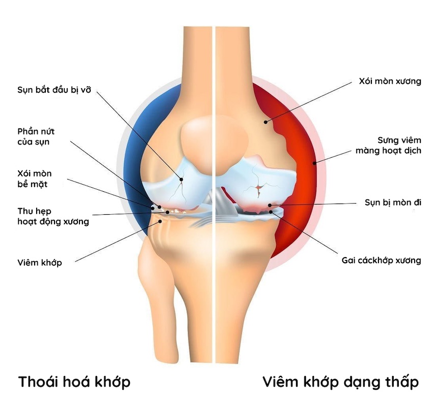 Bệnh viêm khớp là gì