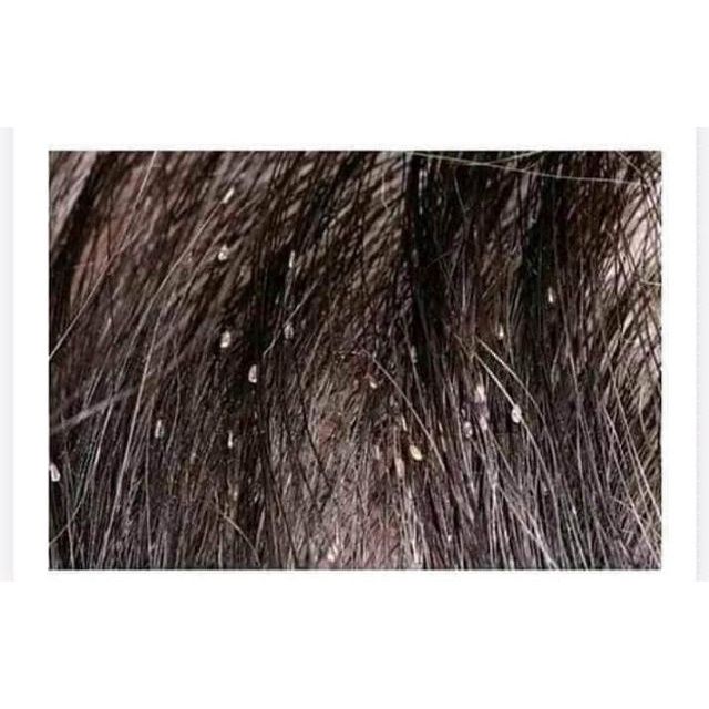 Ủ Chấy Diệt Chấy Gia Truyền Hàng Việt Nam