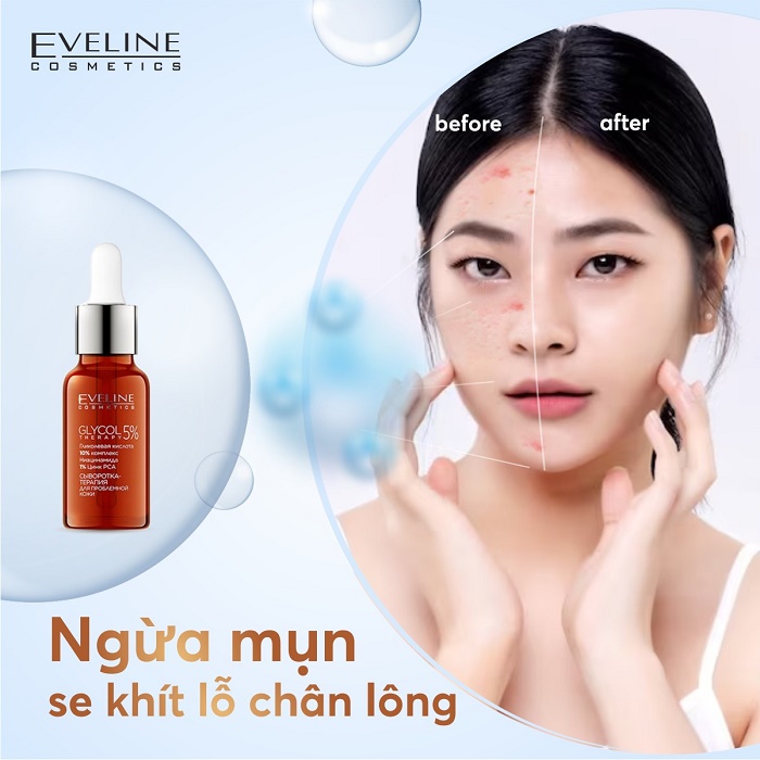 Tinh chất Eveline Glycol Therapy 5% se khít lỗ chân lông, ngừa mụn 18ML 2