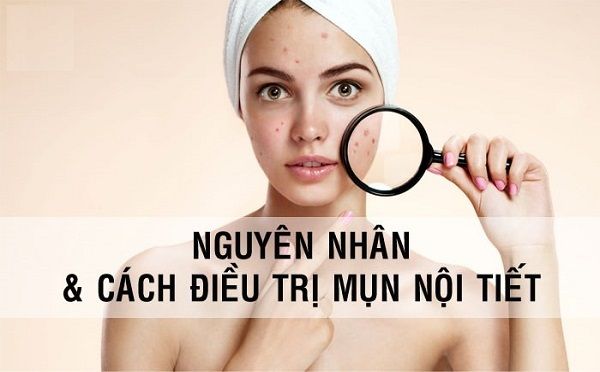 Tìm hiểu nguồn gốc và cách trị mụn nội tiết hiệu quả