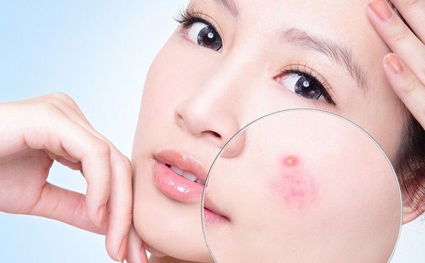 Chia sẻ kinh nghiệm điều trị mụn trứng cá tận gốc