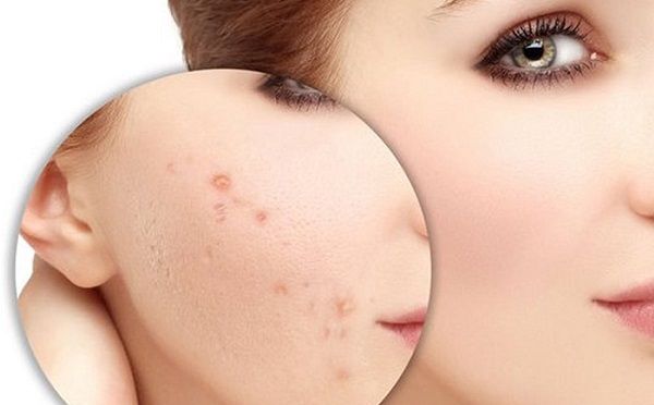 Trị thâm mụn khó hay dễ?