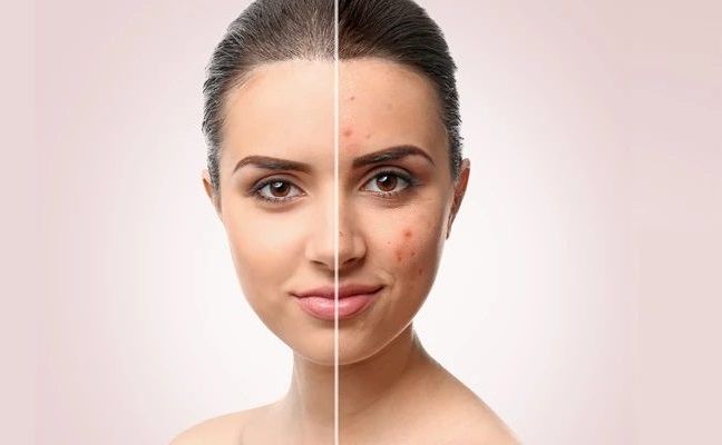 10 mẹo nhỏ giúp bạn loại bỏ mụn trứng cá trên da hiệu quả