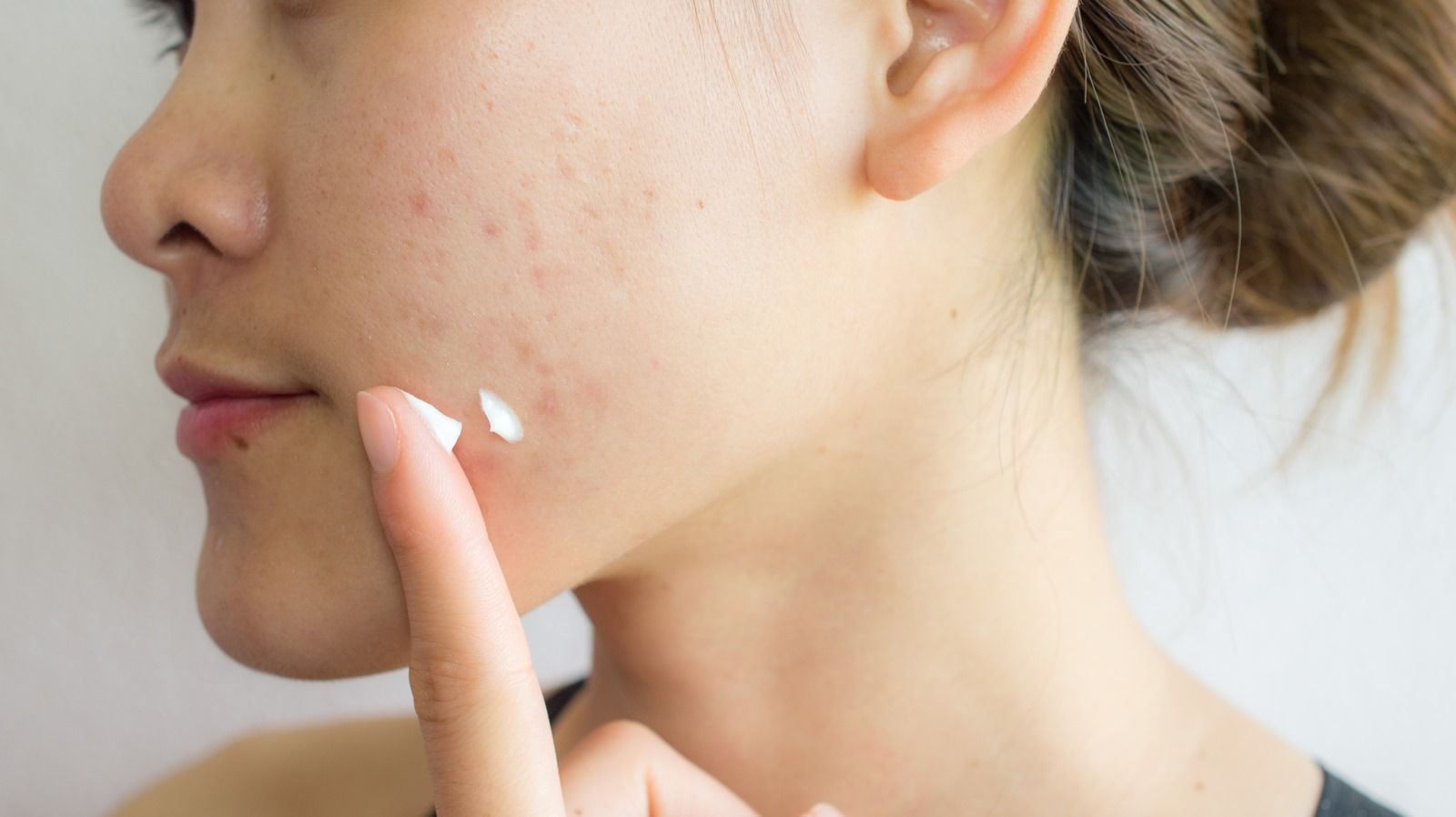 Top 11 thành phần da mụn nên “tránh xa” mà nàng cần phải biết