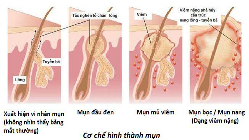 trị mụn, loại da mụn