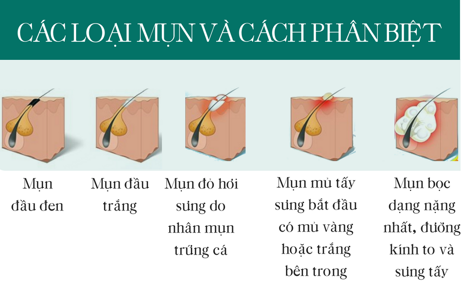 trị mụn, các loại mụn