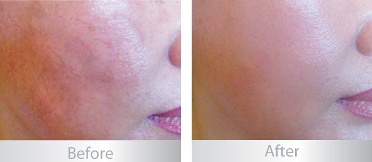 Biologique Recherche Erythros - Serum trị giãn tĩnh mạch và chứng đỏ da đỉnh cao nhất mà mình được thử