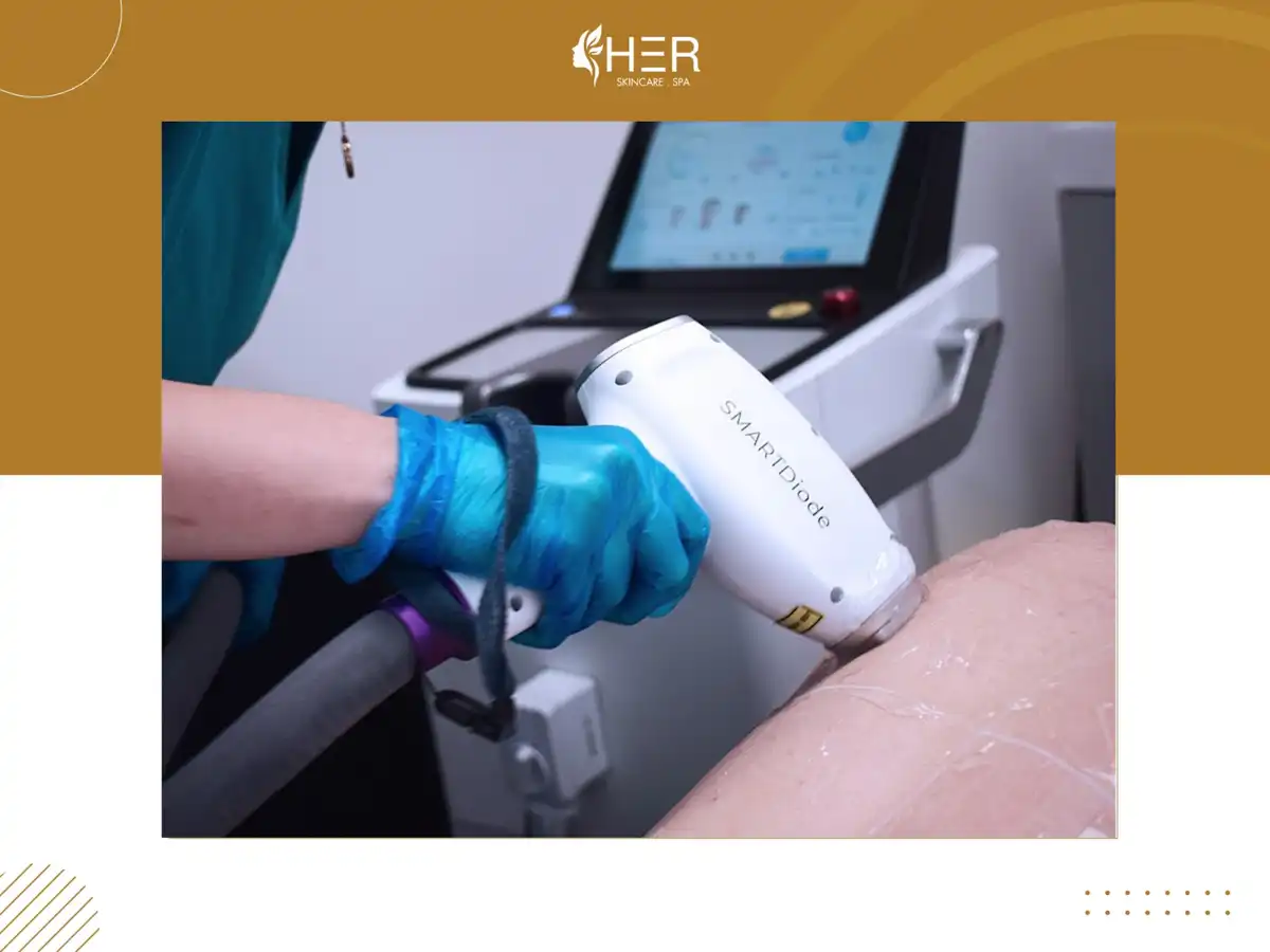 Công nghệ triệt lông Diode Laser hiện đại