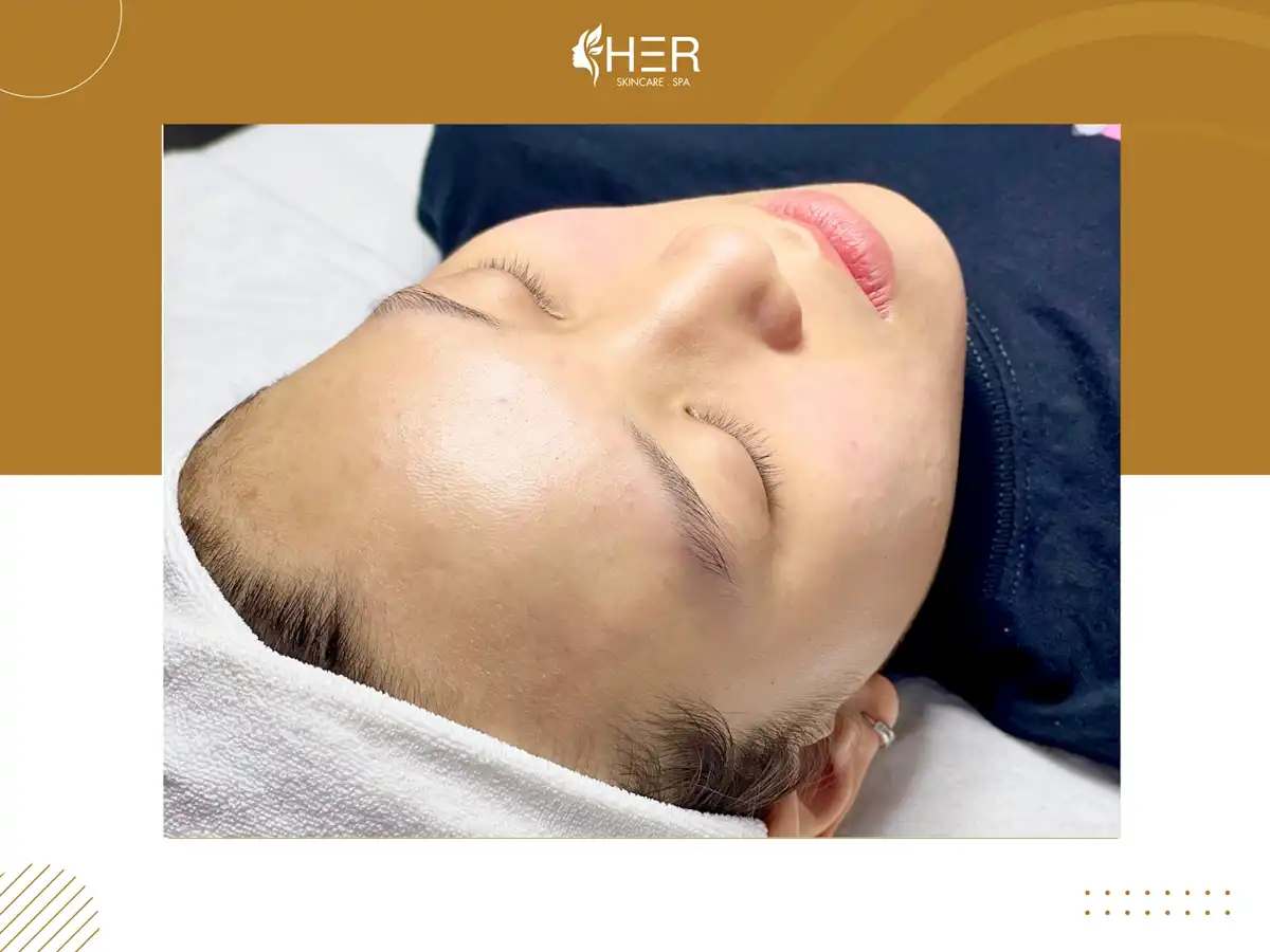 Kỹ thuật trị sẹo Scar Treatment Tách Đáy Sẹo