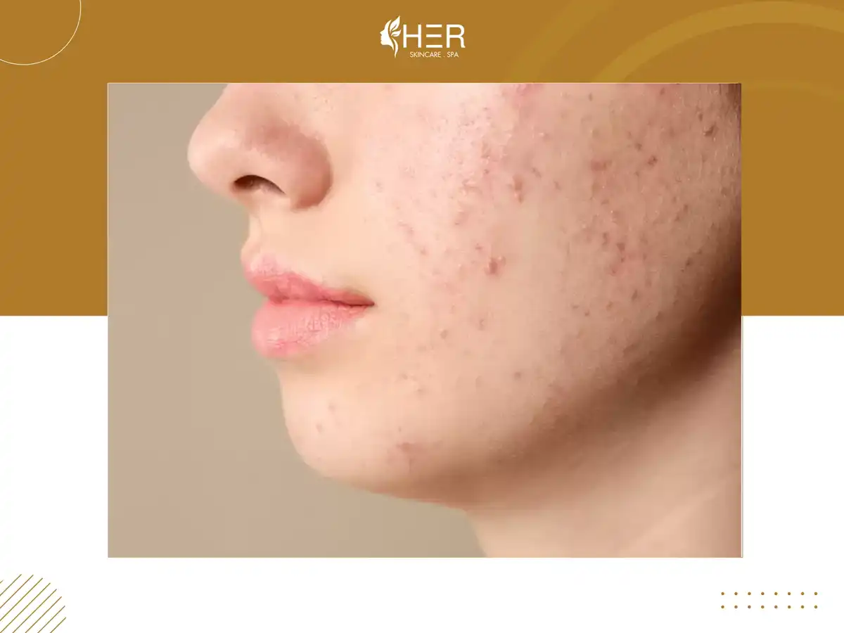 Phương pháp trị sẹo Scar Treatment TCA Cross