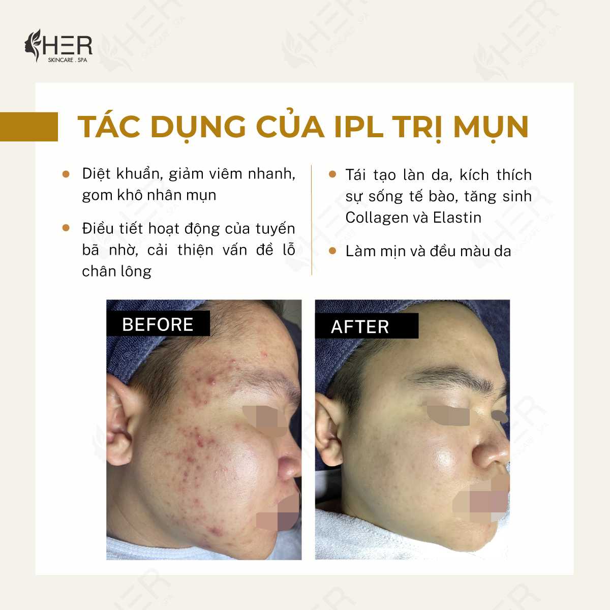 3. Nhược Điểm Của IPL Trong Trị Mụn