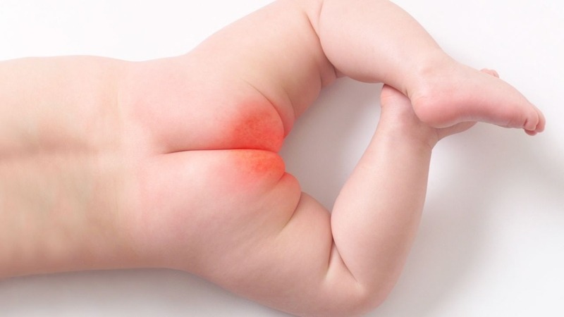 Trẻ Bị Hăm Tã Phải Làm Sao? Nguyên Nhân, Cách Xử Lý Và Phòng Ngừa Hiệu Quả