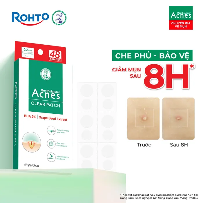 MIENG-DAN-MUN-ACNES-CLEAR-Clear-Acne-Anti-Bacteria-Hop-12-mieng.webp