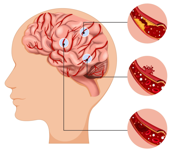 Rối loạn tuần hoàn máu não