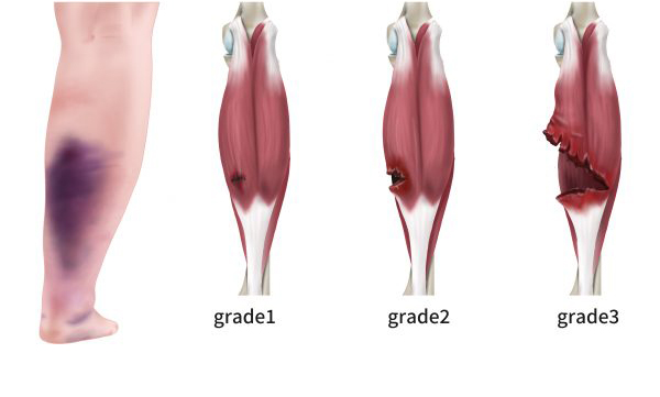 Vết bầm tím do bị rách cơ