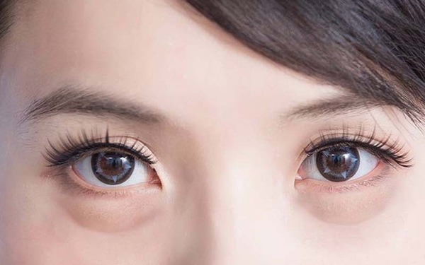Bọng mắt là gì?