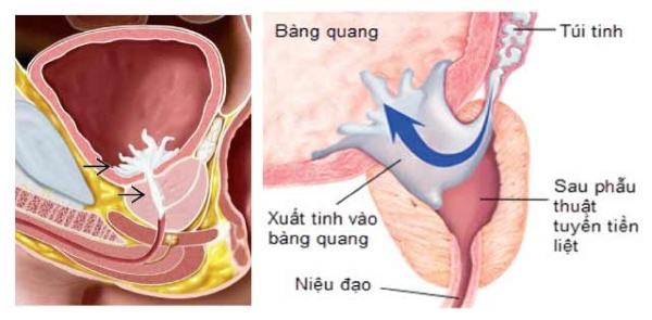 Phương pháp bế tinh là gì?