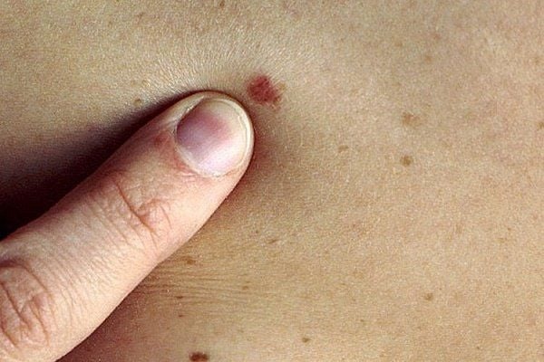 Cải thiện triệu chứng ung thư
