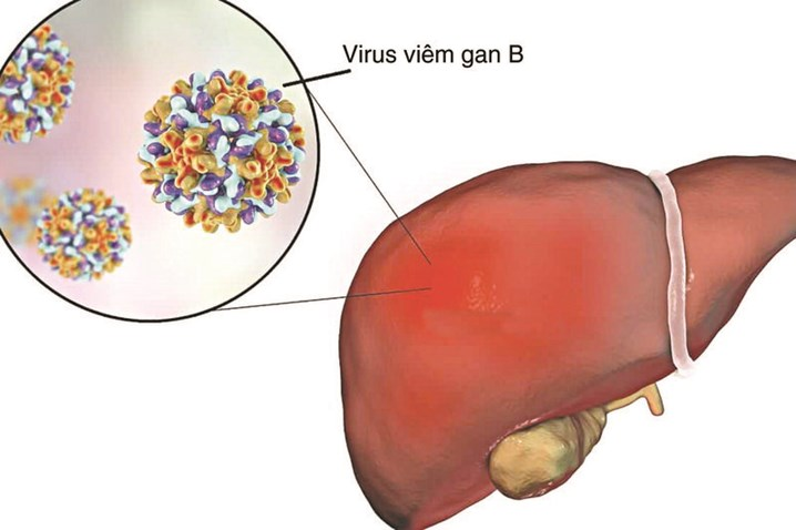 Viêm gan B