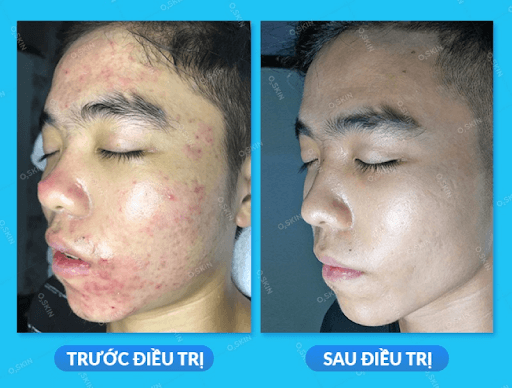 Tập thể dục có giúp giảm mụn không?