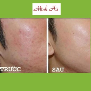 Kem dưỡng phục hồi da mụn BABE Stop AKN Hidratante Repairing Moisturiser 50ml cung cấp độ ẩm ngăn ngừa mụn