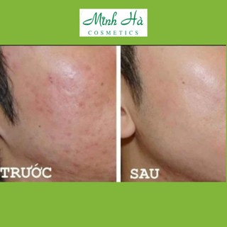 Kem dưỡng Babe Stop AKN Mattifying Moisturiser cho da dầu mụn 50ml kiểm soát dầu thừa, giảm bóng nhờn