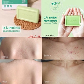Xà phòng Derladie Body Cleansing Bar For Blemish Skin 50g giảm mụn, mờ thâm làm sạch sâu lỗ chân lông
