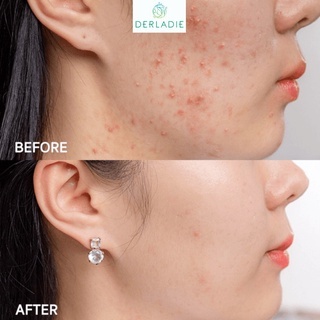 Tinh chất Derladie Herbal Ampoule For Blemish 30ml dành cho da mụn