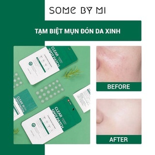 Miếng dán mụn Some By Mi Clear Spot Patch 18 miếng giảm mụn sau 8 giờ