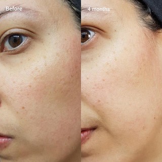 Serum chống lão hóa The Ordinary Retinol 1% in Squalane 30ml cấp ẩm ngăn ngừa lão hóa