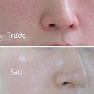 Serum chống lão hóa The Ordinary Retinol 0.5% in Squalane 30ml giúp giảm nếp nhăn