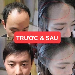 Xịt giảm rụng và kích mọc tóc Minoxidil Bailleul 60ml nuôi dưỡng và kích thích tóc mọc