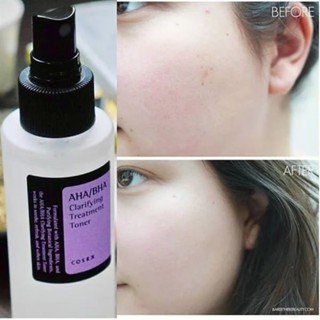 Nước hoa hồng Cosrx AHA/BHA Clarifying Treatment Toner 150ml dành cho da mụn