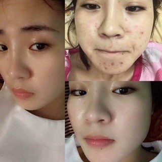 Serum tế bào gốc Ronas Stem Cell Solution hộp 10 ống giúp phục hồi, tái tạo da