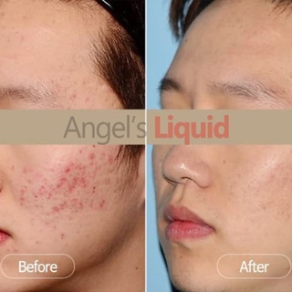 Serum Angel's Liquid Tranexamic Mela Ampoule 30ml giúp da rạng rỡ hồng hào, se khít lỗ chân lông