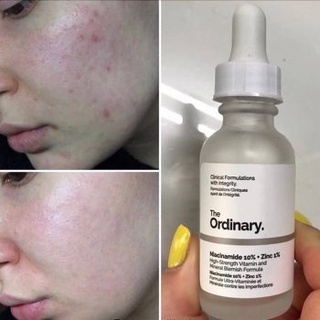 Serum Ordinary Niacinamide 10 Zinc 1% 30/60ml giúp sáng da mờ thâm mụn