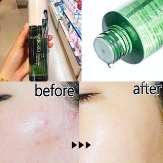 Nước hoa hồng Naruko Tea Tree Shine Control & Blemish Clear Toner 150ml tràm trà hỗ trợ giảm mụn