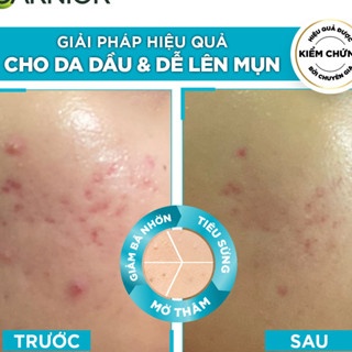 Serum Garnier Bright Complete Anti-Acnes Booster 30ml giảm mụn mờ thâm