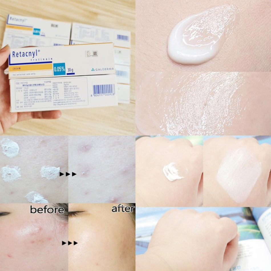 Kem Retacnyl Tretinoin 0.025%/0.05% 30g giảm mụn trứng cá, cải thiện lão hóa da