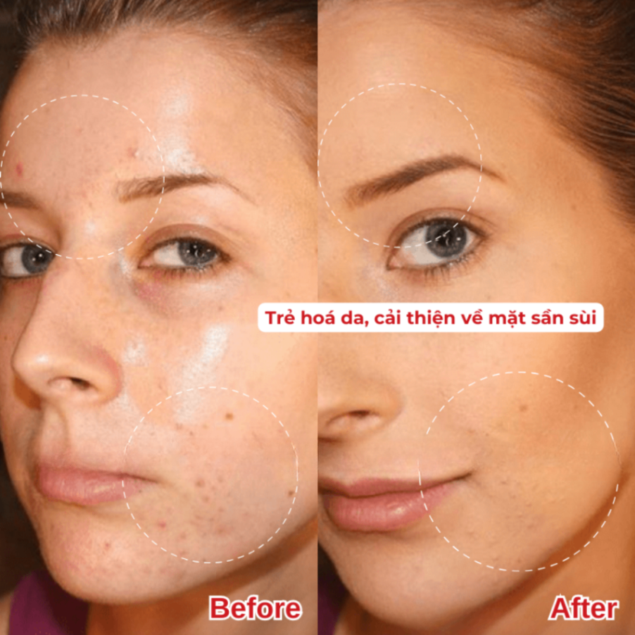 Kem Retacnyl Tretinoin 0.025%/0.05% 30g giảm mụn trứng cá, cải thiện lão hóa da